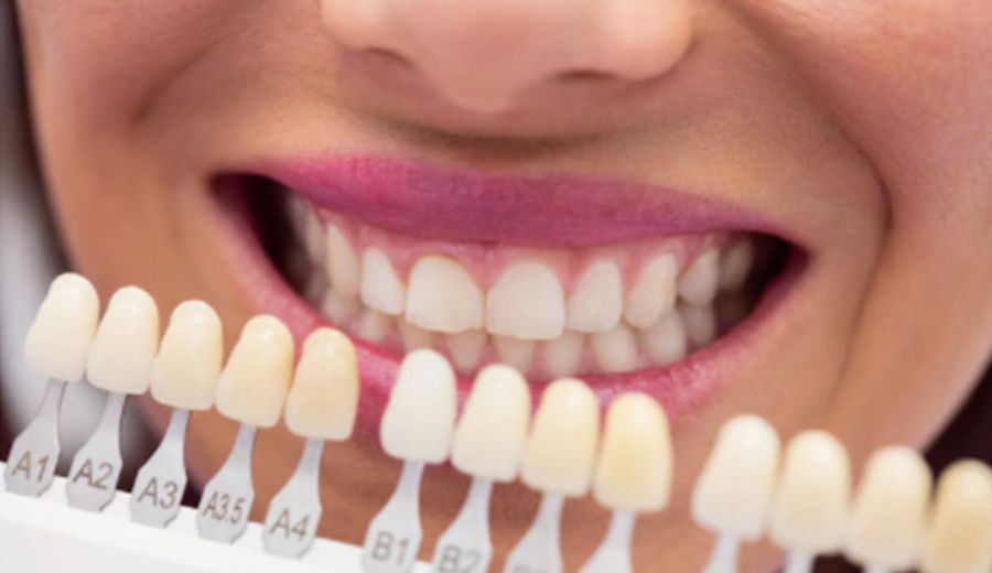 Le secret d’un sourire irrésistible dévoilé : Découvrez les méthodes de blanchiment des dents les plus efficaces !